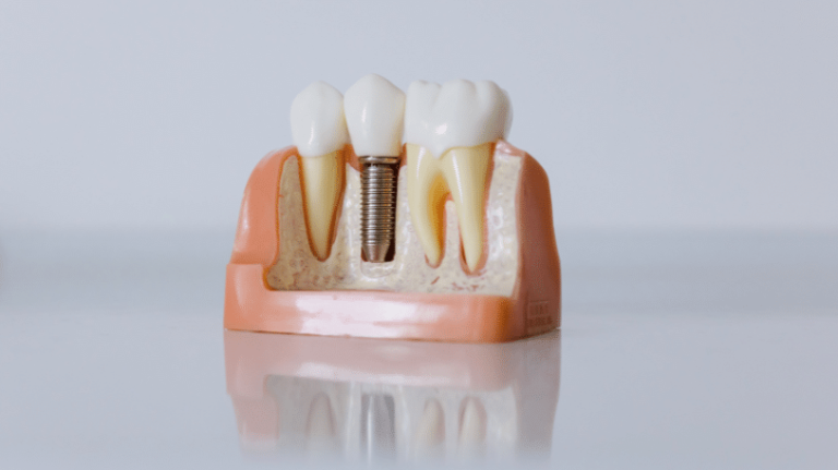 implants-dentaires-paris