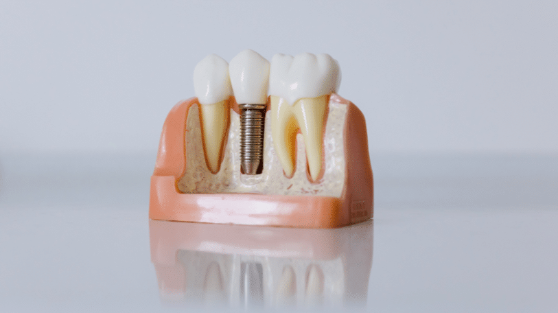 implants-dentaires-paris