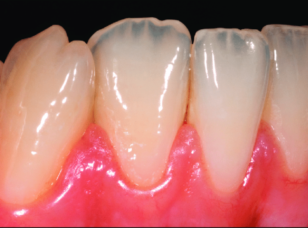 Augmentation-de-la-translucidite-du-collet-vers-le-bord-libre-de-ces-dents-jeunes-Les