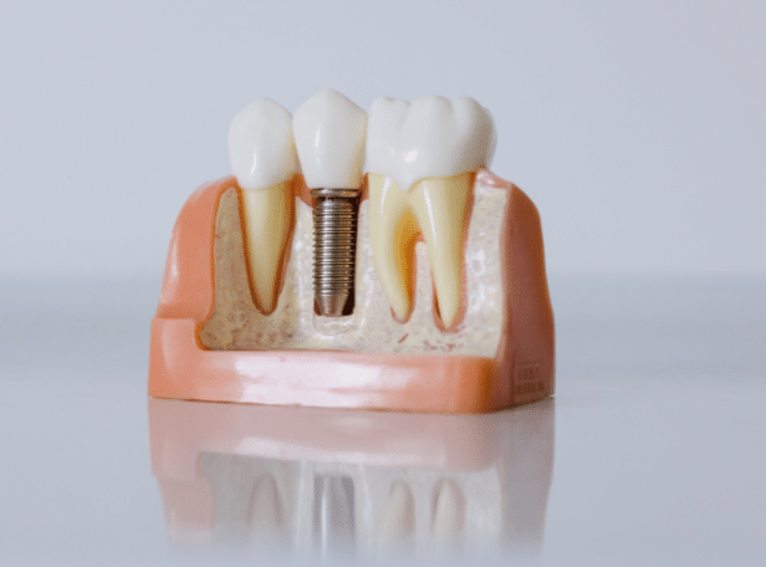 implants-dentaires-paris