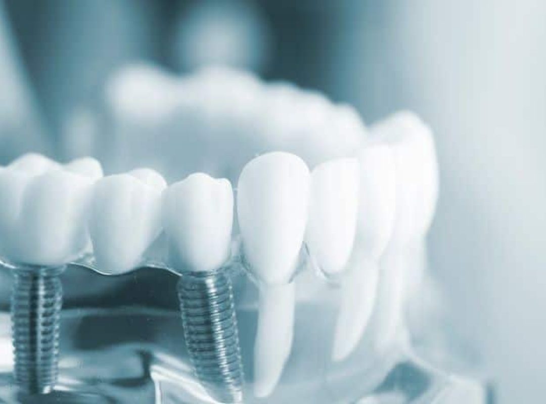 implants dentaires fast dentisterie